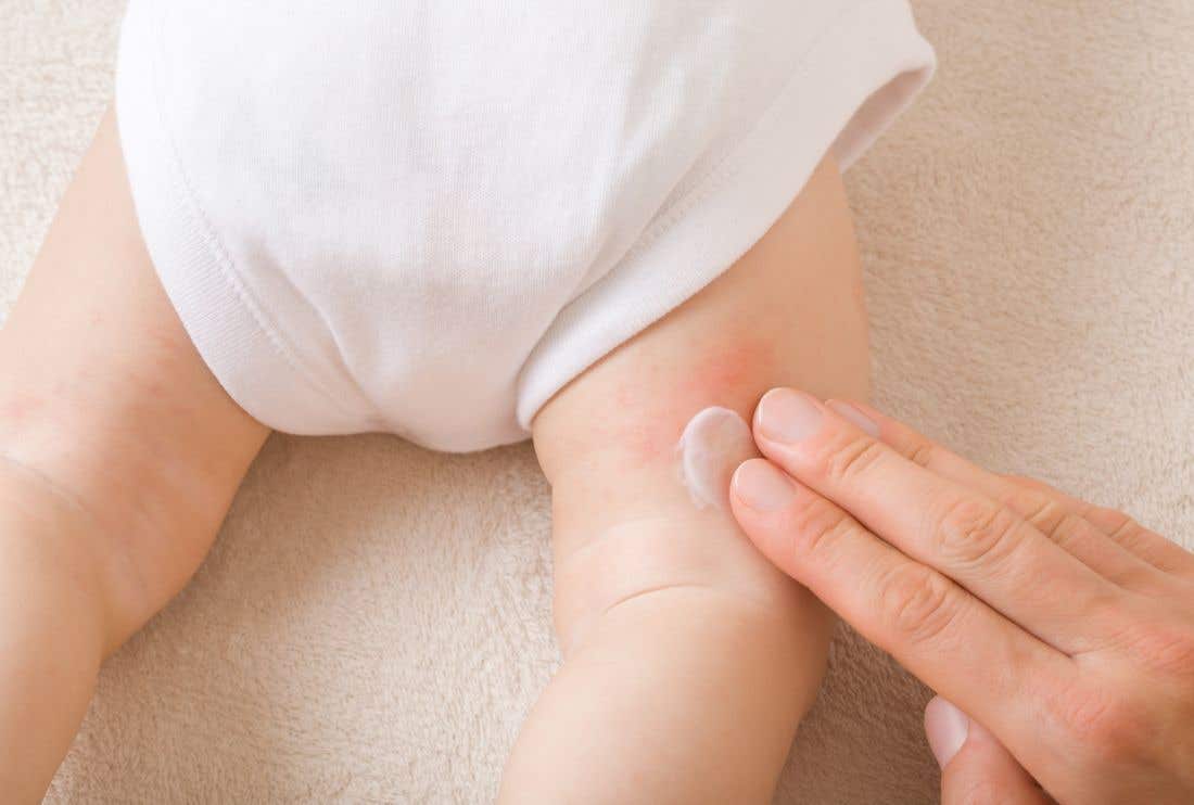 Dermatite da pannolino: sintomi, rimedi e prevenzione